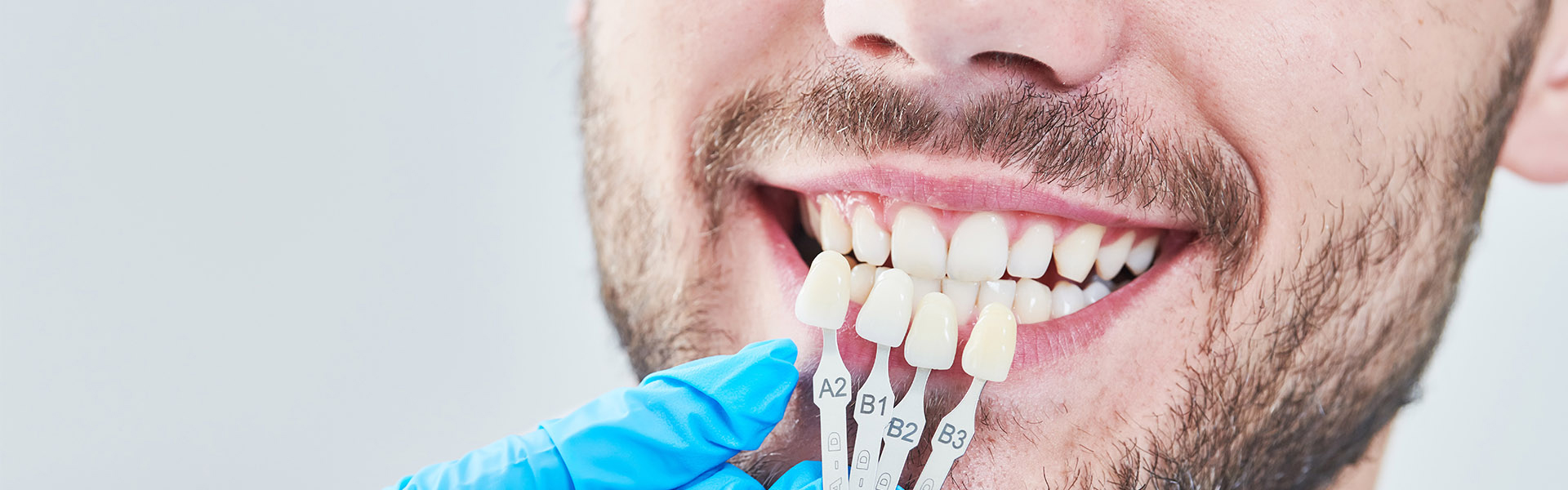 Dental Veneers Help to Treat Various Cosmetic Conditions