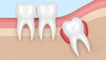 What is Tooth Extractions and What are the Dental Implications of it