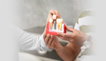 Are Dental Implants A Permanent Solution To Missing Teeth?