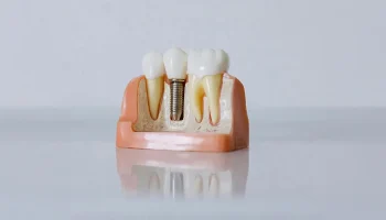 Why Do Dental Implants Get Infected? Causes and Prevention